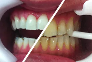 Clareamento Dentário