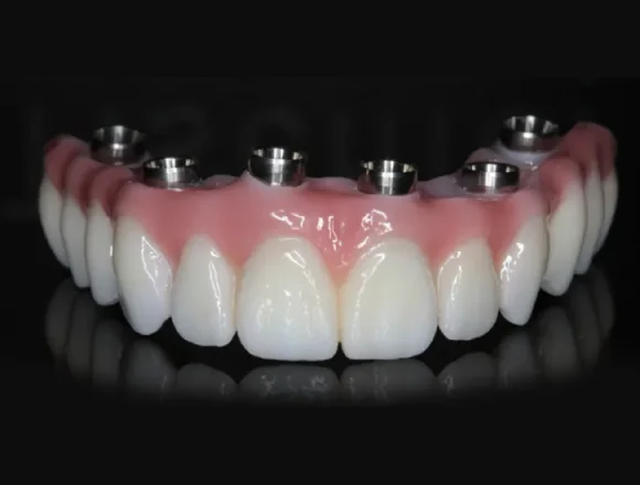 Implantes Dentários