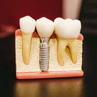 Implantes Dentários